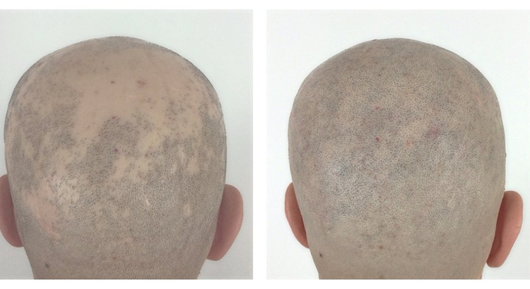 Alopecia-areata-¿qué-es-y-qué-la-causa